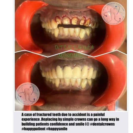 Fractured teeth crown