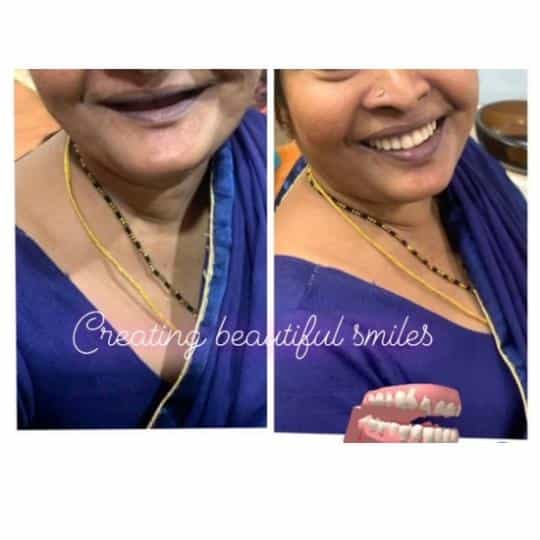 Dentures