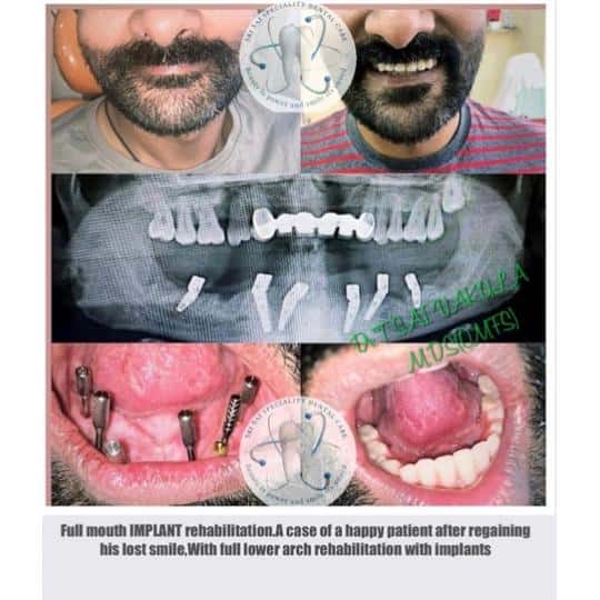 Full mouth implant rehabilitation