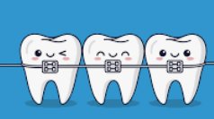Braces