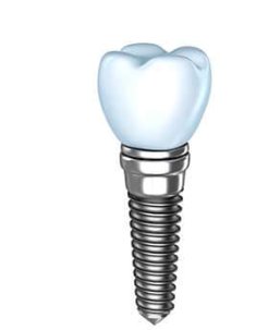 Dental Implant