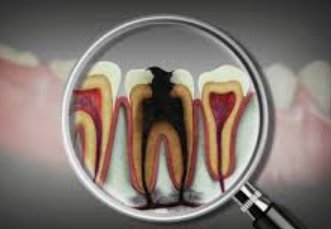 Root Canal